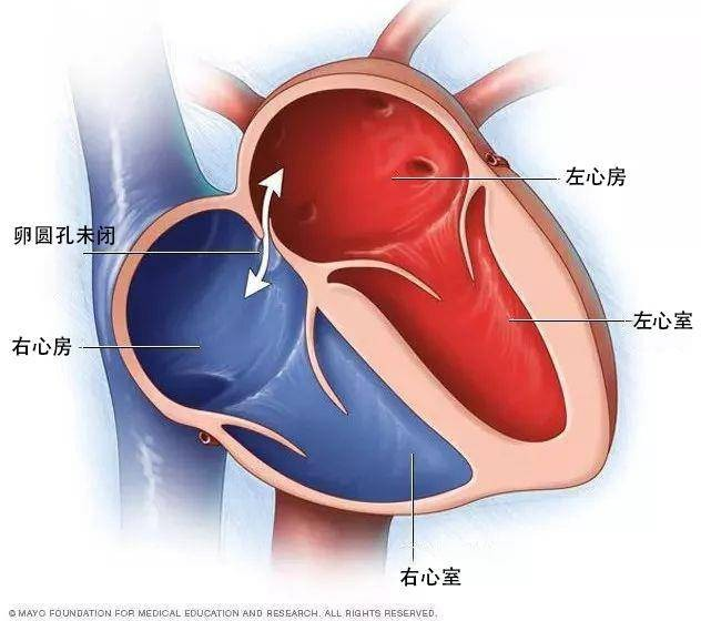 2) 卵圆孔未闭和先天性心脏病有什么区别?